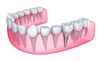 protetică dentară protezare ← ← Articolul