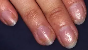 Nail psoriasis kezelésére, fotó és a tünetek