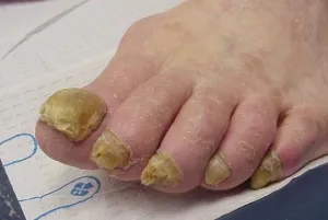 Nail psoriasis kezelésére, fotó és a tünetek