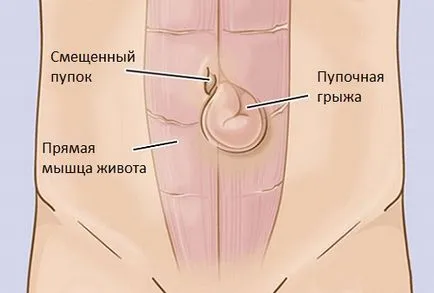 Пъпна херния хирургия при деца с методи за нейното прилагане