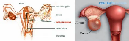 Скъсване на киста на яйчниците симптоми, лечение и последици