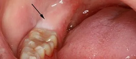 Отглеждане мъдрост поникването на зъбите знаци със снимки