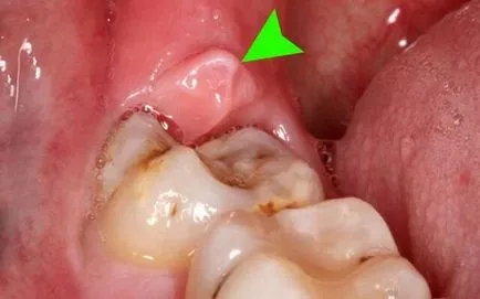 Отглеждане мъдрост поникването на зъбите знаци със снимки