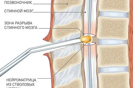 gerincvelő szakadás tünetek, jelek, diagnózis és kezelés