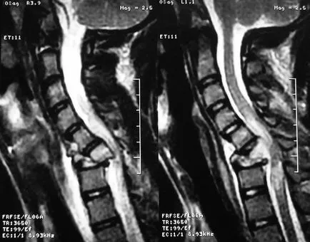 spinarii simptome de ruptura din cordonul ombilical, semne, diagnostic și tratament