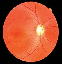 Retinoschisis retina - Causes, tünetek és kezelés