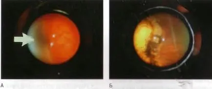 ретинопатия при недоносени