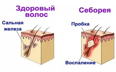 Seborrhea olyan betegség