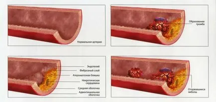 Фамилна хиперхолестеролемия и наследство