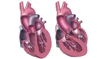 Bolile cardiovasculare la copii angiodysplasia a membrelor inferioare și transpunerea