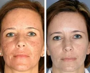 Co2 laser resurfacing