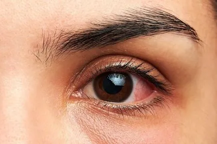 Hámló bőr a szem alatti bőrpír kezelésére és hámlás