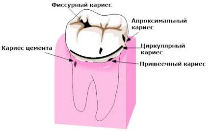 Simptome carii de mijloc și prevenirea dezvoltării bolilor