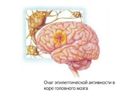 Симптоматично епилепсия при деца причинява, клинични прояви и лечение, бебето е здраво!