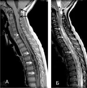 Syringomyelia gerincvelő - tünetei, diagnózisa MRI és a betegségek kezelésére