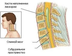 Syringomyelia măduvei spinării - simptome, diagnostic prin RMN si tratamentul bolilor