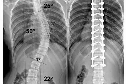 Сколиоза клас 1-4, симптоми и лечение
