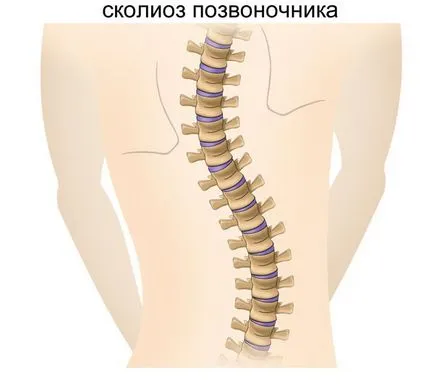 Scolioza - Tratamentul bolii