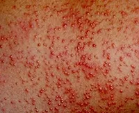 Simptomele urticaria solara si tratamentul stupilor de la soare