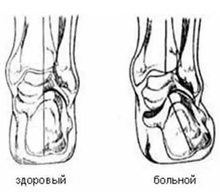 Sunny Meadow - articole - prevenirea și tratamentul platfus