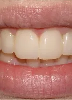 Дентална клиника Smile Design - лечение и възстановяване на зъби, фасети и komponiry,