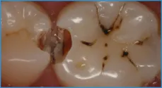 Smile Dental Center interproximalis (pin) fogszuvasodás