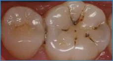 Zâmbet interproximali (PIN) cariilor dentare Center
