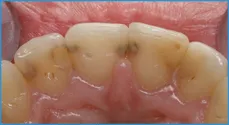 Smile Dental Center interproximalis (pin) fogszuvasodás