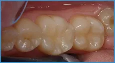 Zâmbet interproximali (PIN) cariilor dentare Center