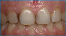 Smile Dental Center интерпроксималните (ПИН) кариес