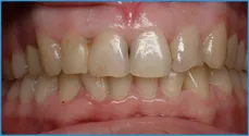 Smile Dental Center интерпроксималните (ПИН) кариес