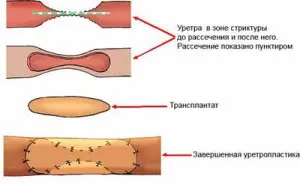 Уретрално структури при мъжете симптомите и лечението на народната и традиционната stredstv