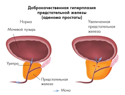 Зимни кресон при лечението на простатит сок, тинктура