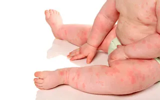 Mérgező dermatitis - okai, tünetei és kezelése (fotó)