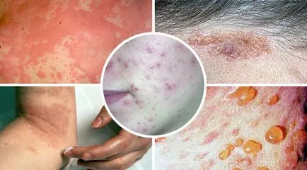 Mérgező dermatitis - okai, tünetei és kezelése (fotó)