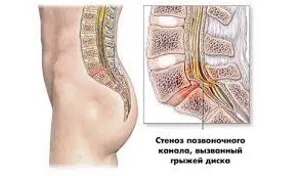 coloanei vertebrale prejudiciu de reabilitare, tratament, recuperare și complicații