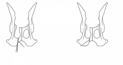 Hármas kismedencei osteotomia