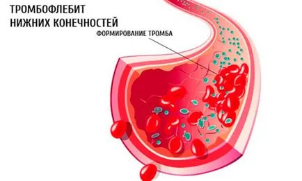 Thrombophlebitis kezelése népi jogorvoslati az alsó végtagok, fű, múmia, sóoldat, kötszerek,