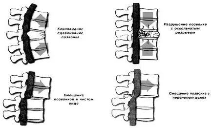 coloanei vertebrale prejudiciu de reabilitare, tratament, recuperare și complicații