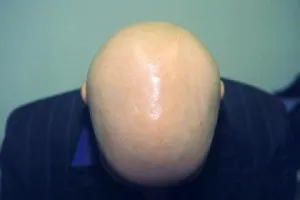 univerzális alopecia