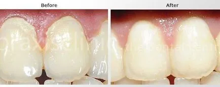 Ultrahangos tisztítás a fogak a kőből