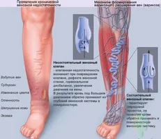 Exerciții cu varice ale membrelor inferioare ajutor reale