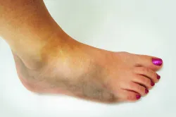remedii echimoze populare picior de tratament