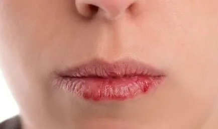 Care Lip