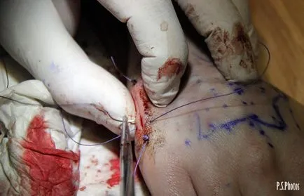 Telepítése szilikon implantátum a kézben