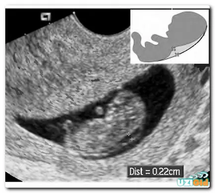 Uzi TVP бременност, малформации, ембрионален патология