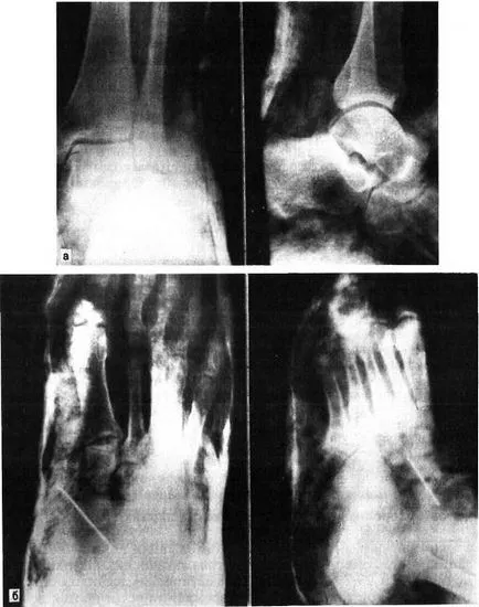 Размествания в крак съвместен Chopart - крак хирургия, фрактури и наранявания на краката - хирургия и лечение