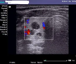 hematom intracranian la copii tratați