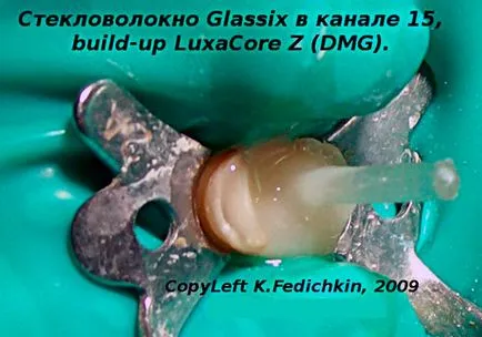 Възстановяване на rezortsinennogo на зъб пън