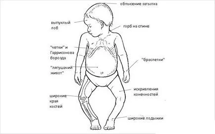 picioare în formă de X în curburii copii tratați